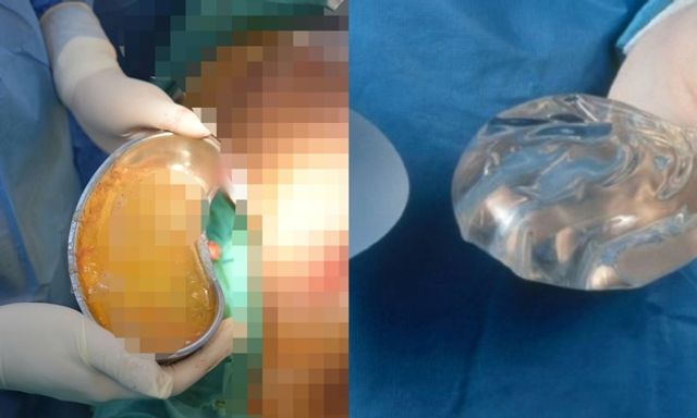 Bi hài hậu vận sau thẩm mỹ: Mẹ bầu 