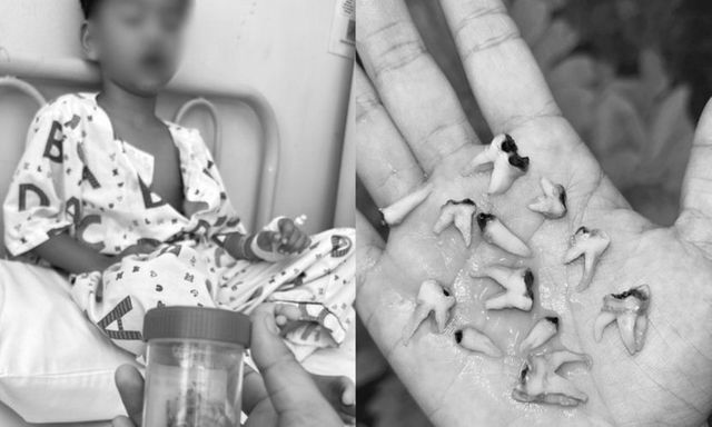 Bé trai phải nhổ một lúc 12 chiếc răng do thói quen sai lầm sau khi uống sữa