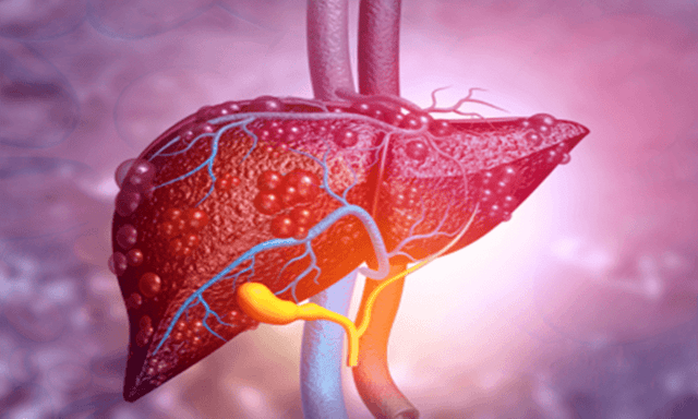 Xơ gan, viêm gan, gan nhiễm mỡ - Biến chứng tiểu đường ít ai ngờ