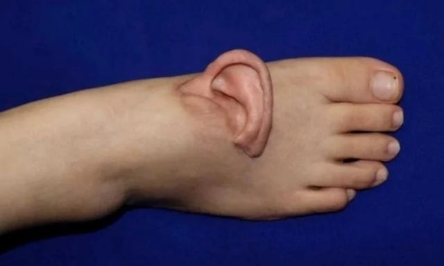 Hy hữu: Bác sĩ hồi sinh kỳ diệu chiếc tai đứt bằng cách cấy lên chân bệnh nhân