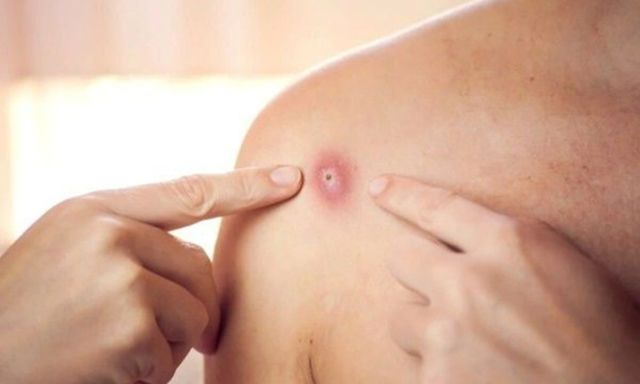 Tin tức đời sống 11/12: Ghi nhận ca đậu mùa khỉ đầu tiên trong năm ở Đồng Nai