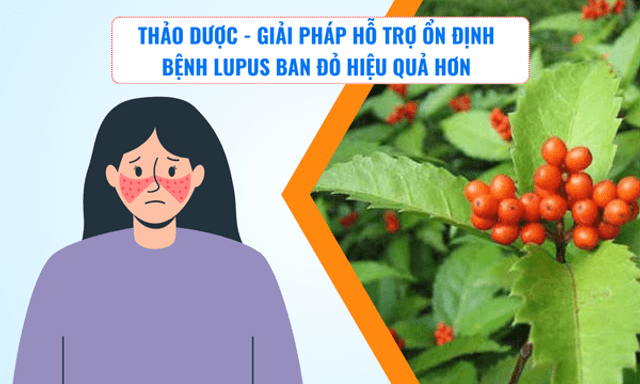 Thảo dược - Giải pháp hỗ trợ ổn định bệnh lupus ban đỏ hiệu quả hơn
