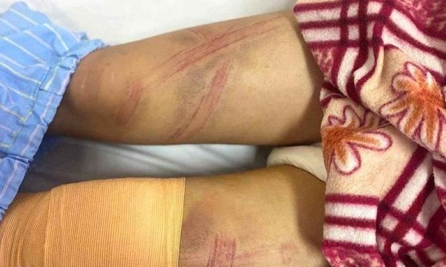 Vụ nữ sinh ở Nghệ An nhập viện với nhiều vết bầm tím: Lãnh đạo phường nói gì?