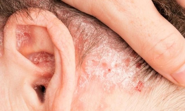 Dấu hiệu trên da tưởng vô hại lại là 