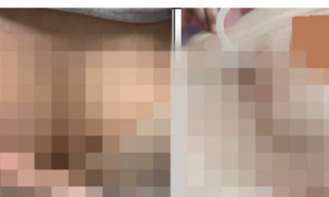 Tiêm filler vào ngực, cô gái 30 tuổi trả giá đắt từ lời quảng cáo 