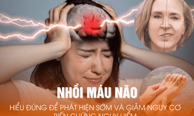 Nhồi máu não: Hiểu đúng để phát hiện sớm và giảm nguy cơ biến chứng nguy hiểm