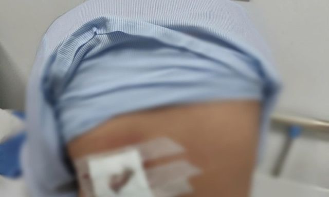 Tin tức đời sống 15/1: Đắp lá điều trị mụn lưng, người phụ nữ bị hoại tử