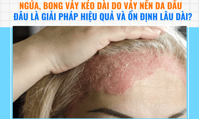Ngứa, bong vảy kéo dài do vảy nến da đầu – Đâu là giải pháp cải thiện hiệu quả?