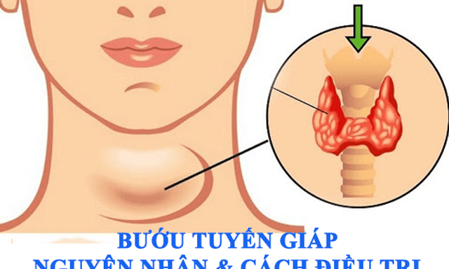 Bướu tuyến giáp: Nguyên nhân, triệu chứng và cách kiểm soát hiệu quả