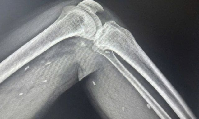 Phát hiện kén sán ở chân bệnh nhân do thói quen nhiều người mắc