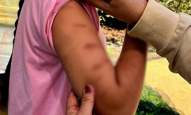 Vụ nữ sinh lớp 5 nghi bị bạo hành: Thông tin mới nhất