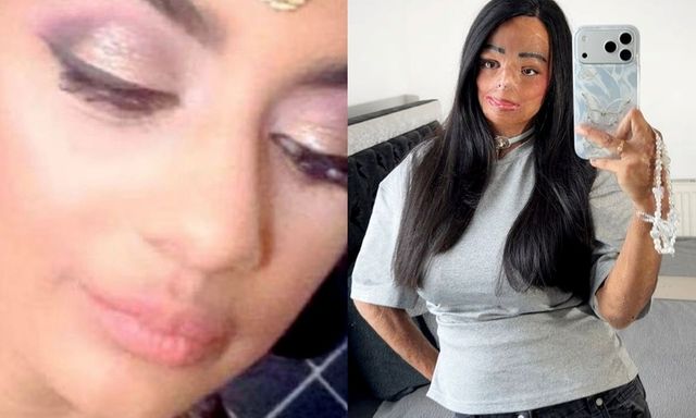 Dầu gội đầu trị chấy bắt lửa, thiếu nữ xinh đẹp bị bỏng nửa người và mất 7 ngón tay