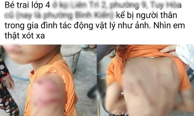 Công an vào cuộc vụ bé trai 10 tuổi nghi bị bạo hành ở Đắk Lắk