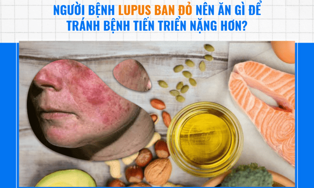 Người bệnh lupus ban đỏ nên ăn gì để tránh bệnh tiến triển nặng hơn?