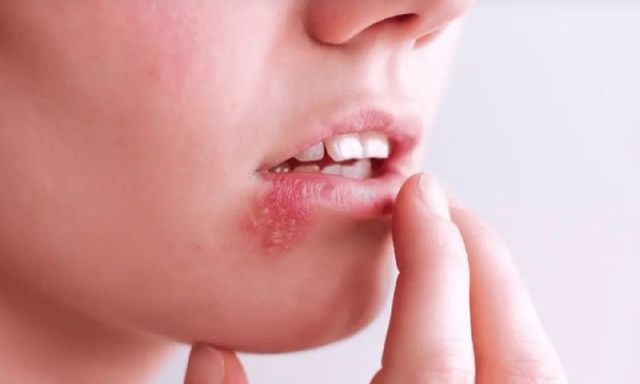 Chủ quan với nốt mụn rộp ở miệng, người phụ nữ 30 tuổi rơi vào tình trạng chết não