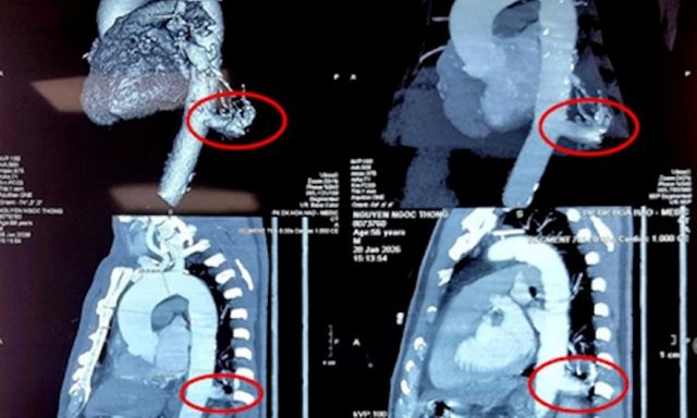 Lần đầu tiên, Việt Nam dùng robot mổ điều trị phổi biệt lập thành công