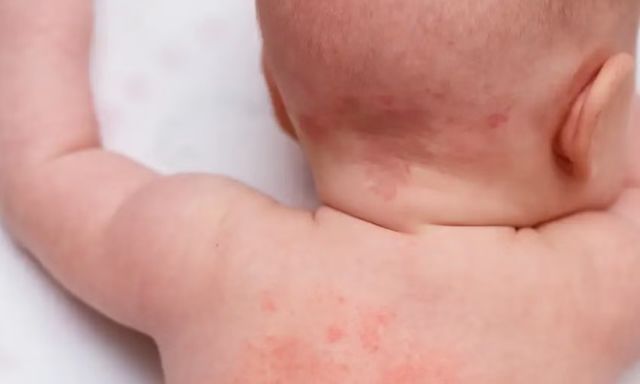 Rôm sảy ở trẻ nhỏ: Hiểu đúng để chăm sóc da bé an toàn và hiệu quả