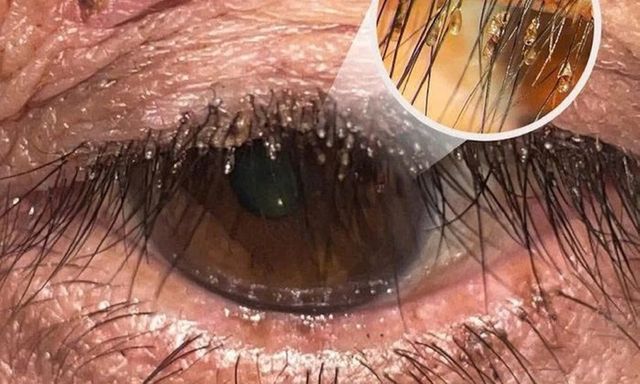 Tin tức đời sống 17/3: Ổ rận mu bám chi chít trên lông mi người phụ nữ