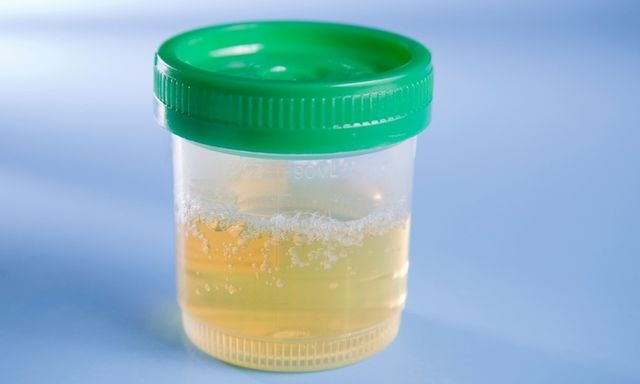 5 dấu hiệu từ nước tiểu cảnh báo thận đang 