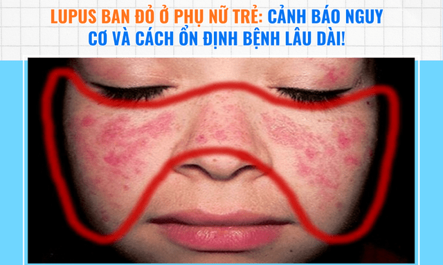 Lupus ban đỏ ở phụ nữ trẻ: Nhận diện nguy cơ và cách kiểm soát lâu dài