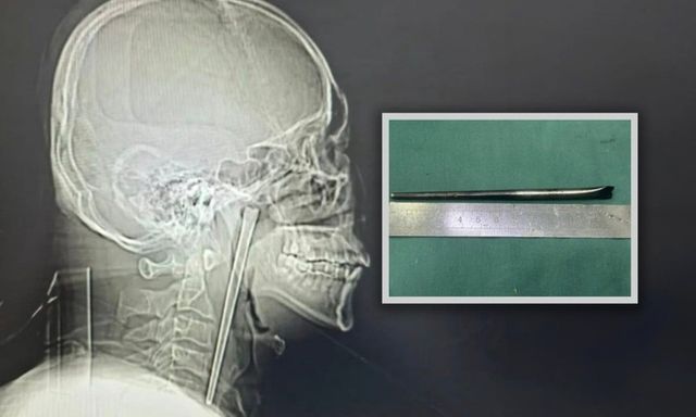 Cứ ngõ đau họng do uống rượu, bác sĩ sốc nặng khi gắp ra vật dài 12cm từ cổ bệnh nhân