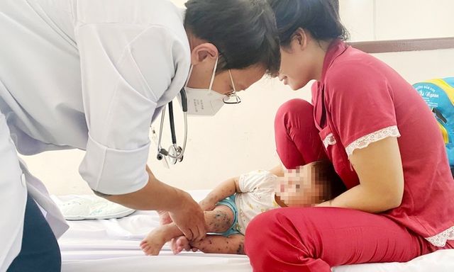 Ca tay chân miệng ở TP.HCM tăng cao: Cách nhận biết sớm và chủ động phòng ngừa