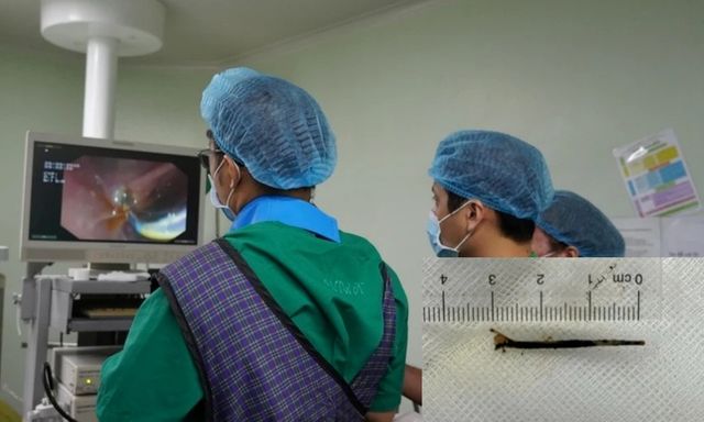 Đau bụng âm ỉ nhiều tháng không khỏi, chàng trai sốc nặng khi biết nguyên nhân