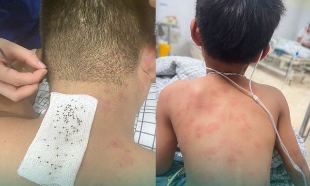 Đi tìm tổ chim, hai cha con bị ong mật đốt với hơn 300 vết đốt
