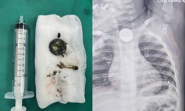 Bé 24 tháng tuổi bị bỏng sâu thực quản do nuốt pin cúc áo