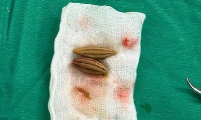 Cấp cứu cụ bà thủng trực tràng do nuốt nhầm hạt nhót