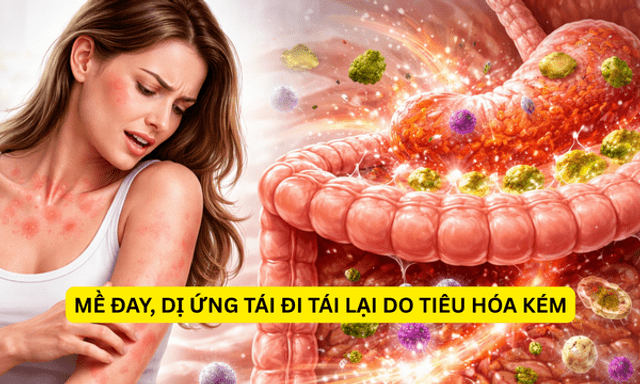 Mề đay, mẩn ngứa kéo dài có thể bắt nguồn từ đường ruột