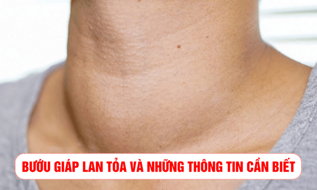 Bướu giáp lan tỏa và những thông tin cần biết