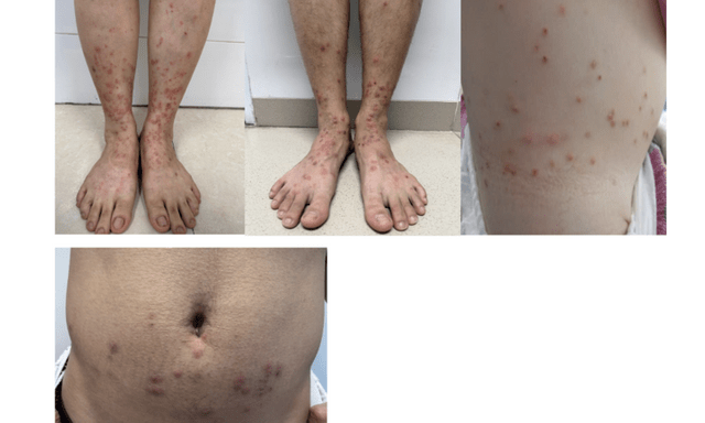 Bọ chét “tấn công”, nhiều người nhập viện vì tự điều trị tại nhà