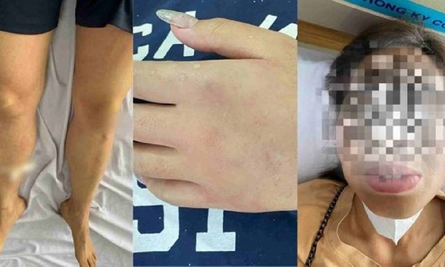 8 người nhập viện cấp cứu do ong rừng tấn công khi đi tảo mộ