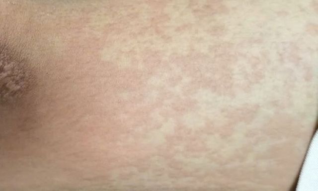 Ăn 2 con ve sầu, nam sinh 17 tuổi nhập viện cấp cứu trong đêm