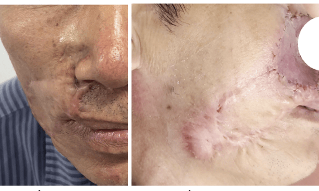 “Mổ đi mổ lại” vẫn tái phát: Bác sĩ cảnh báo ung thư da âm thầm xâm lấn