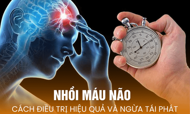 Nhồi máu não: Cách điều trị hiệu quả và ngừa tái phát