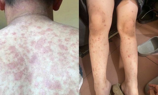 Đi bơi về ngứa rát, nổi mụn mủ: Dấu hiệu cảnh báo bệnh da cần đi khám sớm