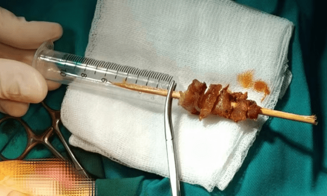 Bé gái 2,5 tuổi gặp nạn khi ăn thịt xiên nướng