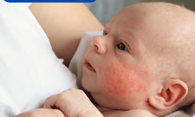 Viêm da ở trẻ nhỏ: Hiểu đúng để chăm sóc hiệu quả