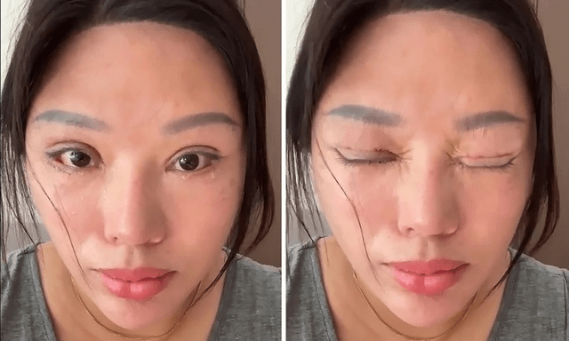 Cắt mí mắt hỏng đến mức tàn tật, nạn nhân vẫn phải đền tiền tỷ cho thẩm mỹ viện