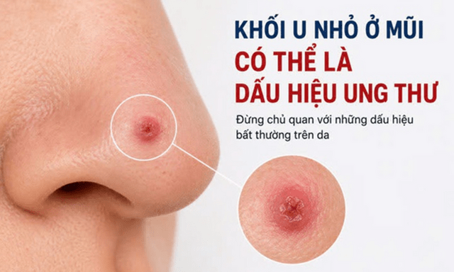 Dấu hiệu ung thư da dễ nhầm với mụn thông thường