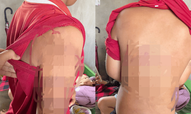 Bà hoảng hồn phát hiện trên người cháu đầy vết bầm tím, vội trình báo công an