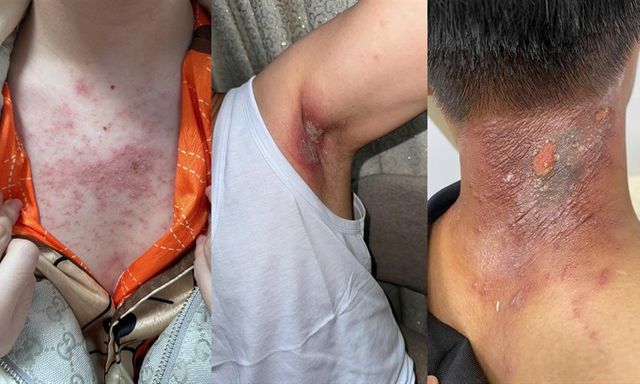 Kiến ba khoang gây bỏng rát da: Bác sĩ chỉ ra sai lầm nhiều người mắc khiến tổn thương nặng hơn