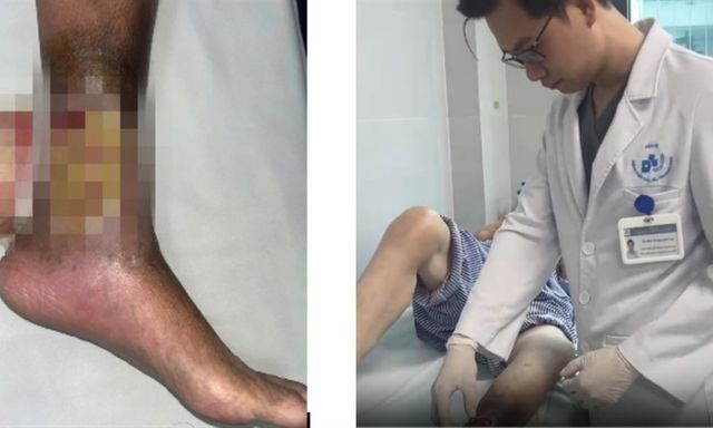 Tự điều trị vết loét chân kéo dài, người phụ nữ đối mặt nguy cơ biến chứng