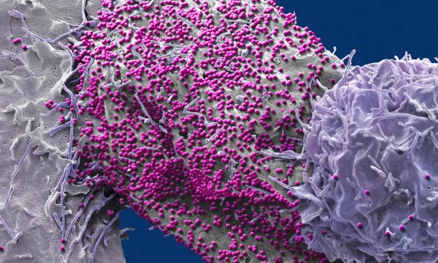 Nóng: Bệnh nhân nam 60 tuổi khỏi hoàn toàn HIV nhờ ghép tế bào gốc