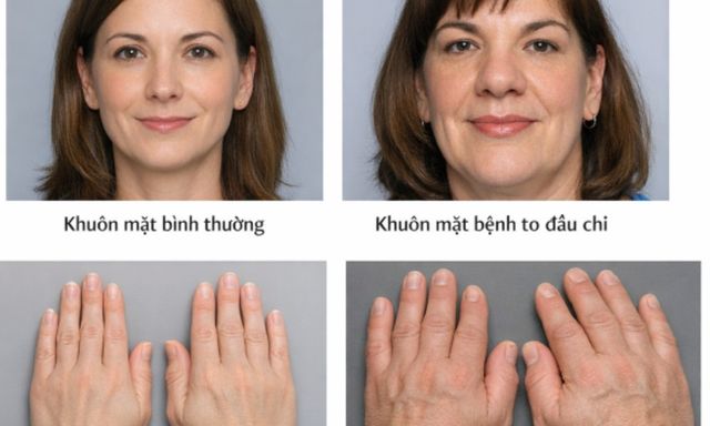 Khuôn mặt, tay chân bỗng béo lên bất thường: Bệnh viện Bạch Mai cảnh báo dấu hiệu của căn bệnh nguy hiểm