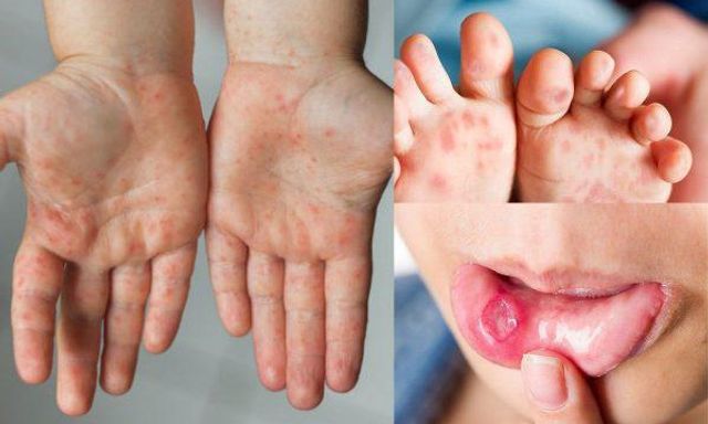 Bệnh viện Nhi TW cảnh báo một bệnh dịch đã 