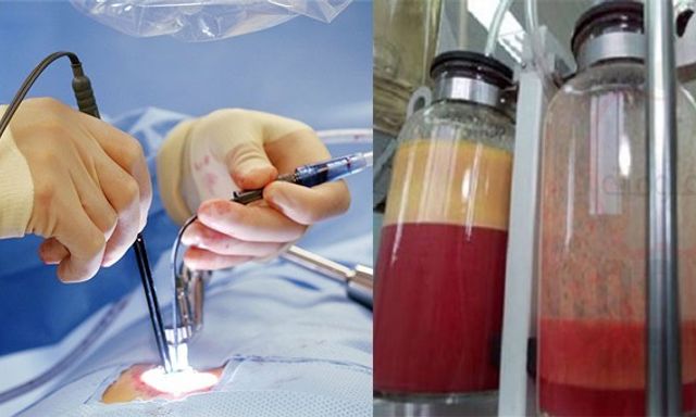 Bê bối của thị trường thẩm mỹ trị giá 22 tỉ USD: nạn nhân nức nở kể trải nghiệm HÚT MỠ đau đớn 