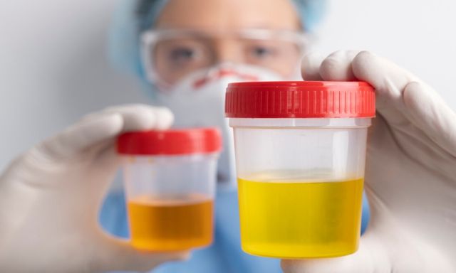 Hướng dẫn phân biệt màu nước tiểu khi thận suy?